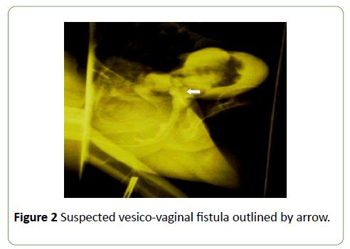 gynecology-obstetrics-vesico-vaginal-fistula