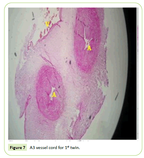 gynecology-obstetrics-vessel-cord