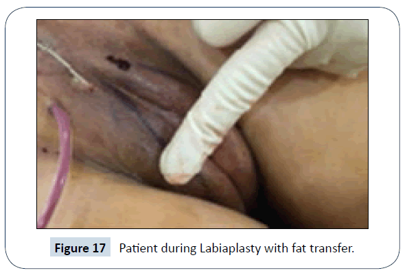 healthcare-communications-Labiaplasty