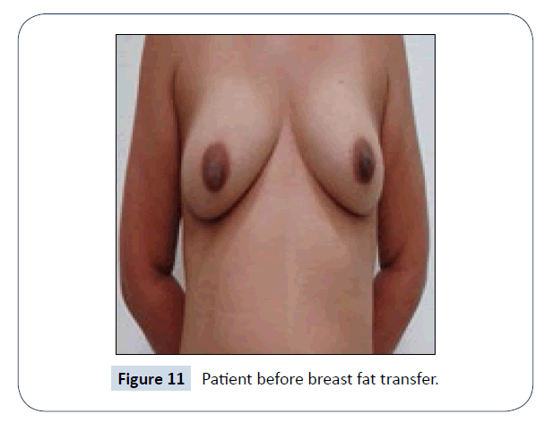 healthcare-communications-before-breast