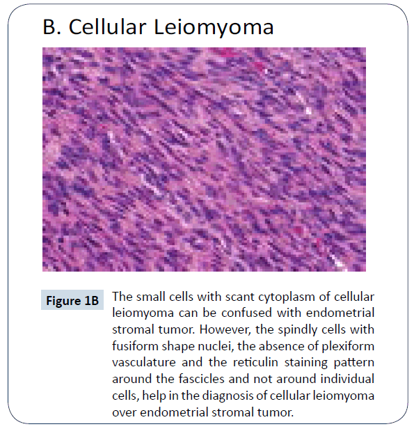 healthcare-communications-cellular-leiomyoma