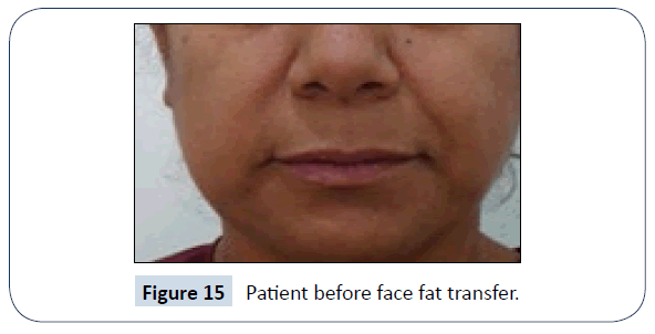 healthcare-communications-face-fat