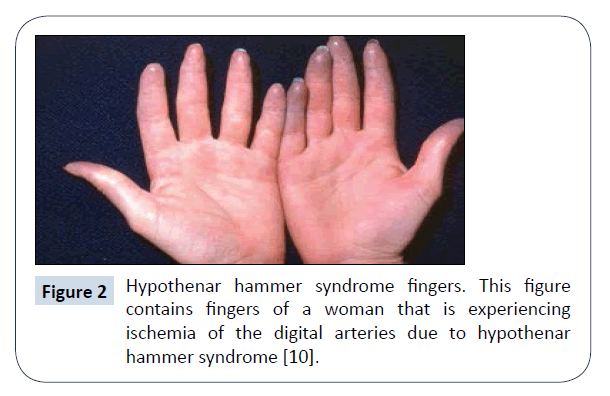 healthcare-communications-hammer-syndrome
