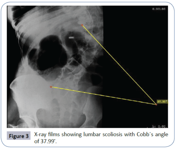 healthcare-communications-lumbar-scoliosis