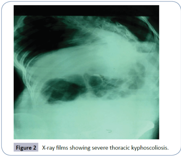 healthcare-communications-severe-thoracic-kyphoscoliosis