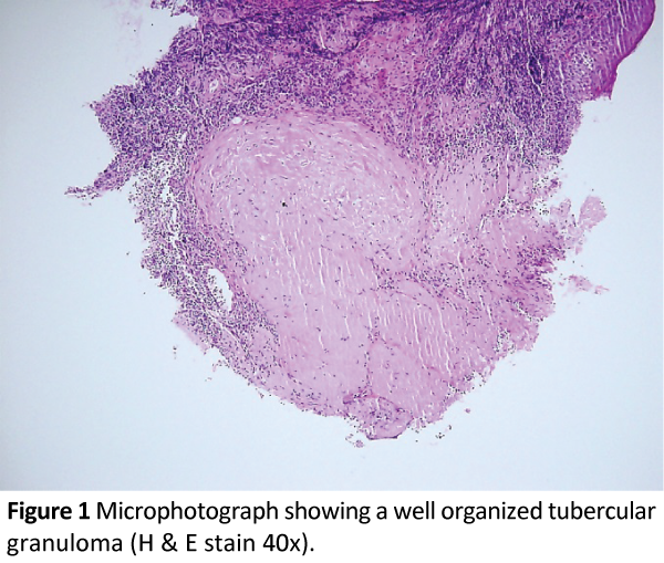 infectious-diseases-and-treatment-tubercular-granuloma