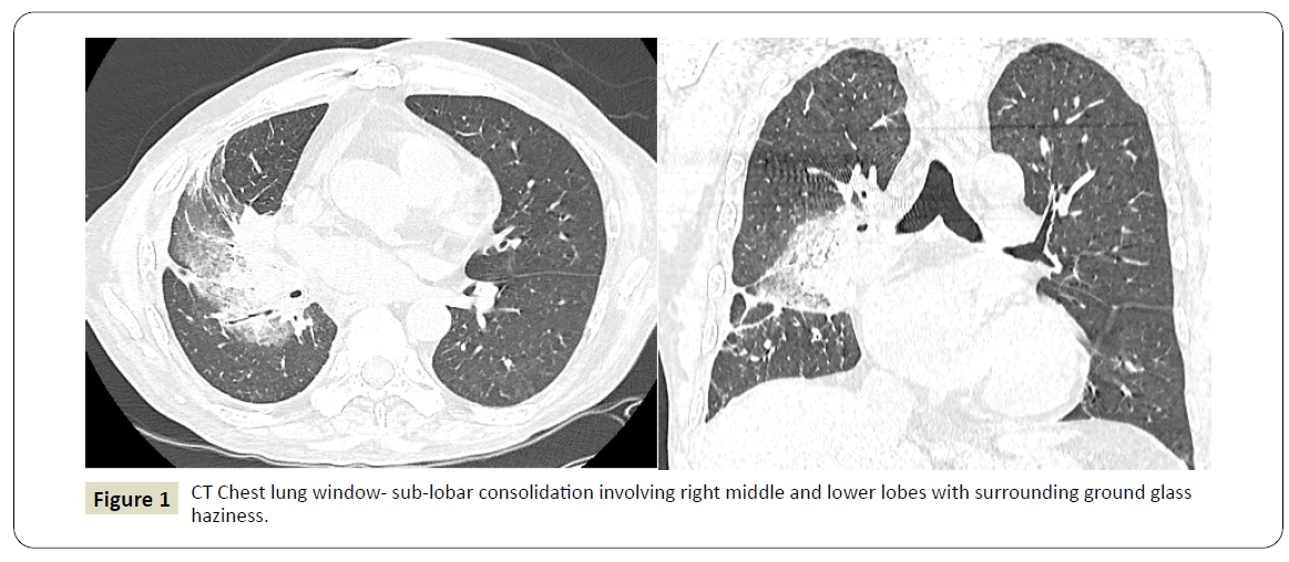 intensive-critical-care-sub-lobar-consolidation