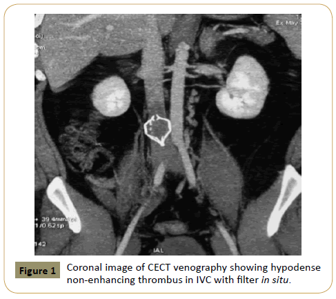 intensive-critical-care-venography