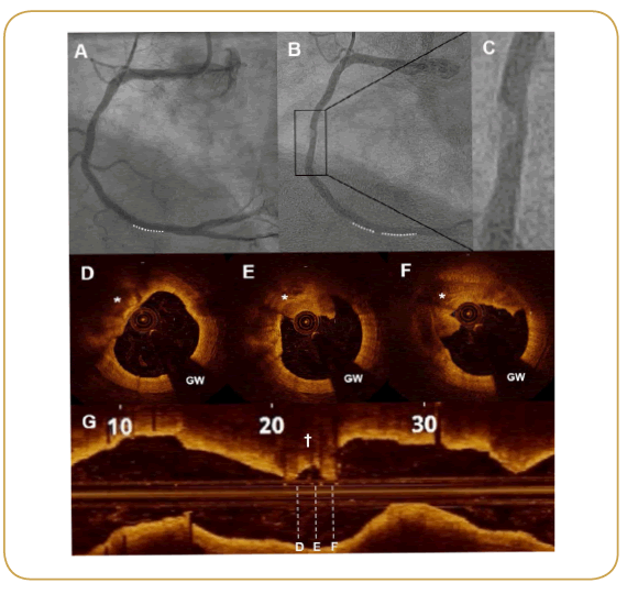 interventional-cardiology