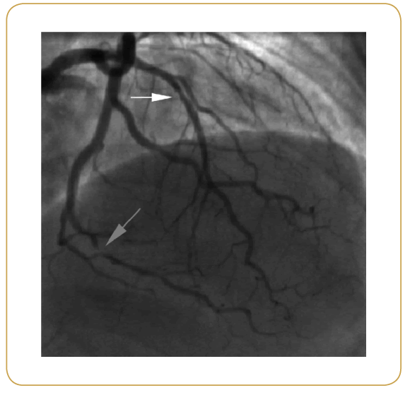 interventional-cardiology