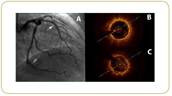 interventional-cardiology