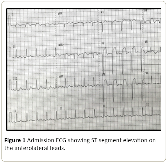 interventional-cardiology-Admission-ECG