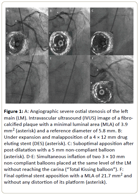 interventional-cardiology-Angiographic-severe-ostial-stenosis