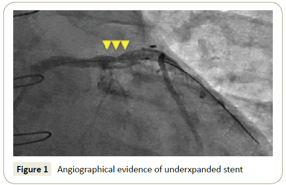 interventional-cardiology-Angiographical