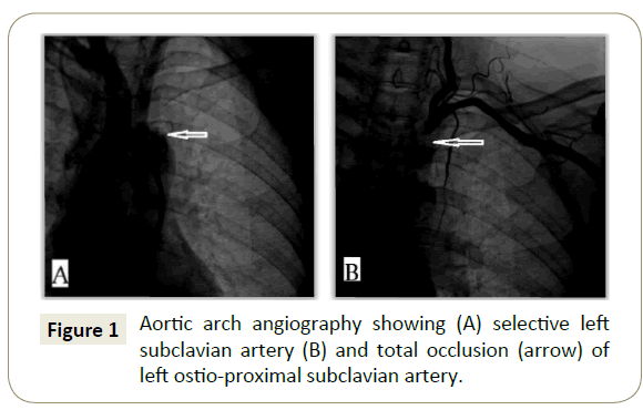 interventional-cardiology-Aortic-arch