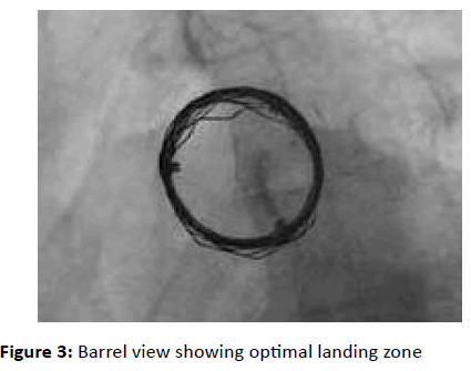 interventional-cardiology-Barrel-view