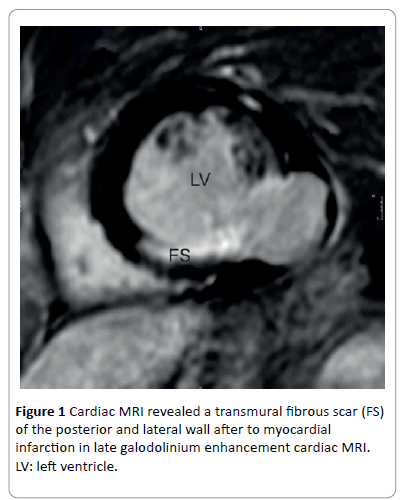interventional-cardiology-Cardiac-MRI-revealed-transmural-fibrous