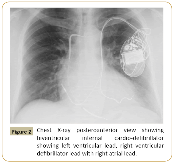 interventional-cardiology-Chest-X-ray