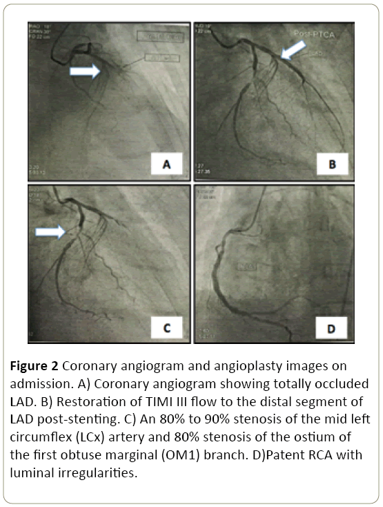 interventional-cardiology-Coronary-angiogram