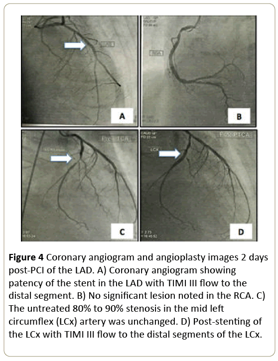 interventional-cardiology-Coronary-angiogram