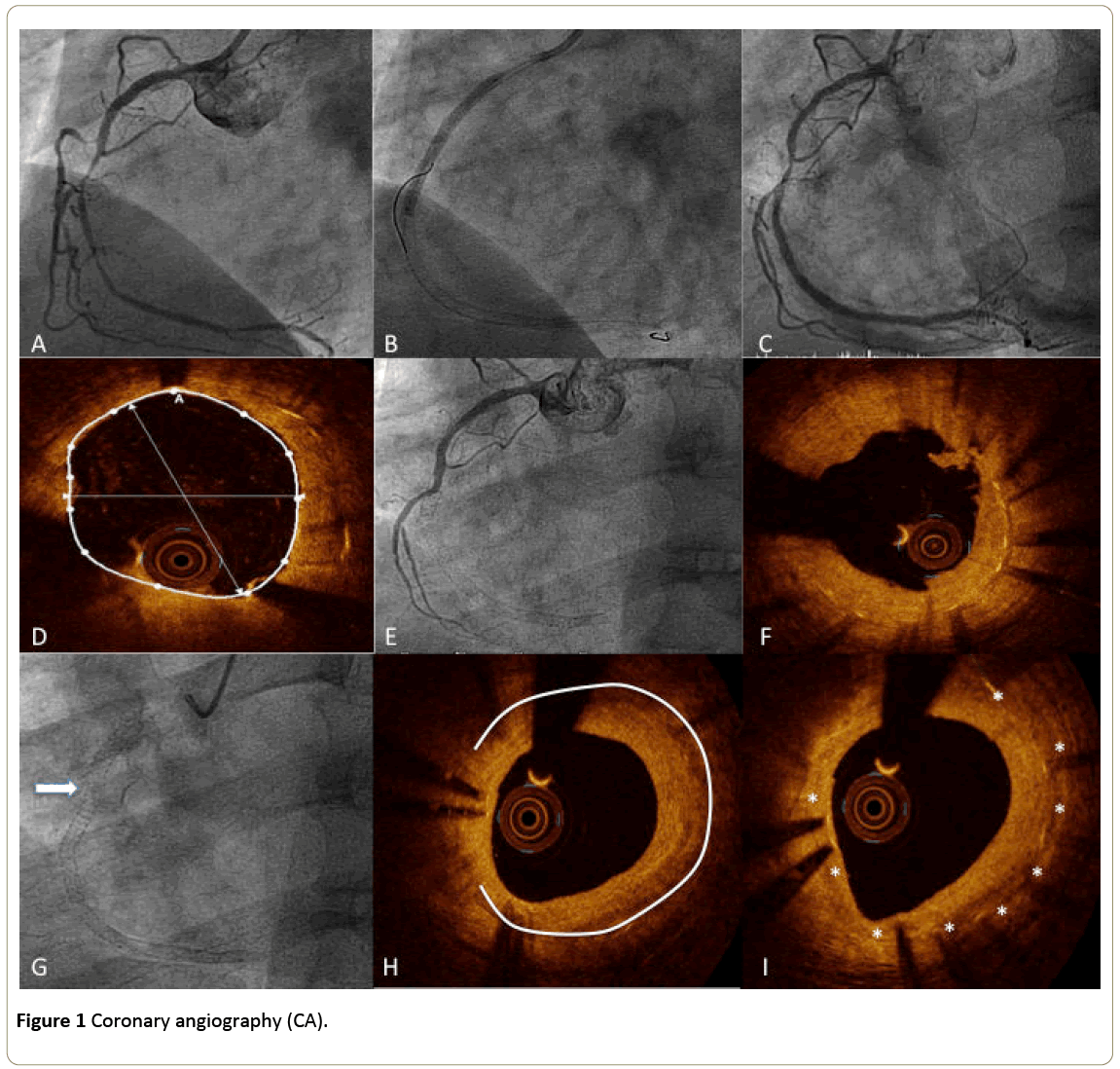 interventional-cardiology-Coronary-angiography