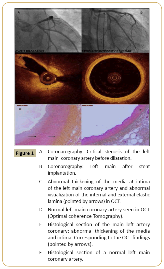 interventional-cardiology-Critical-stenosis