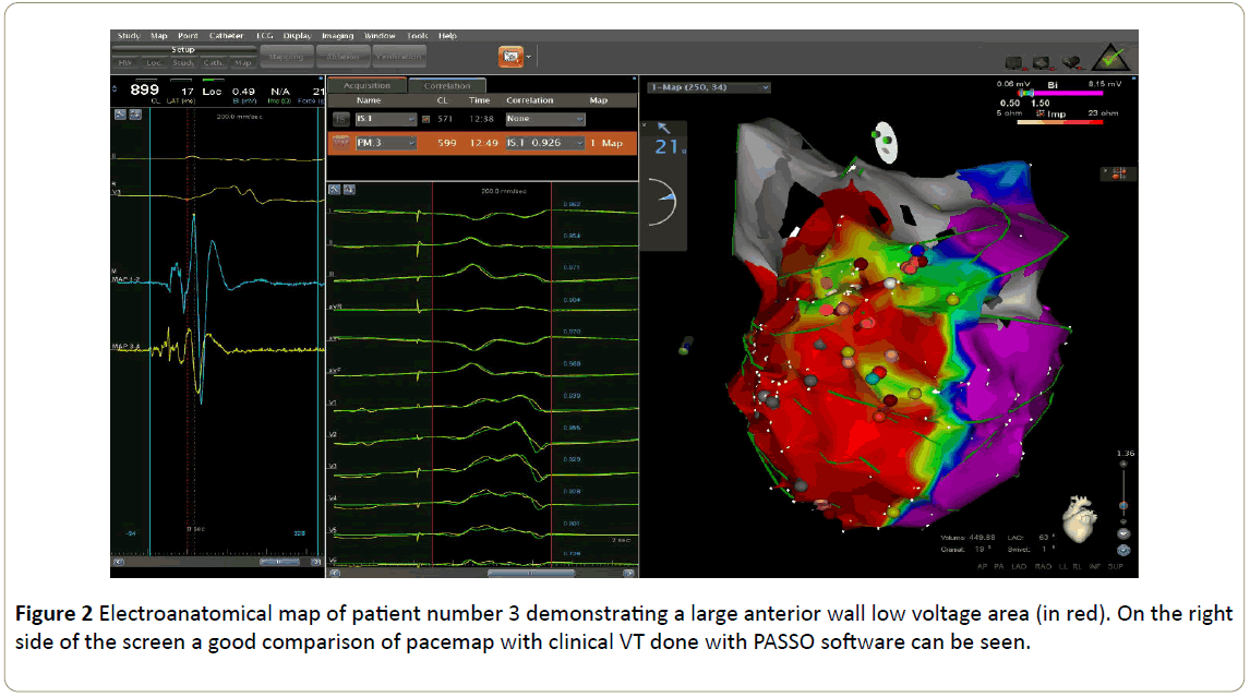 interventional-cardiology-Electroanatomical-patient-voltage