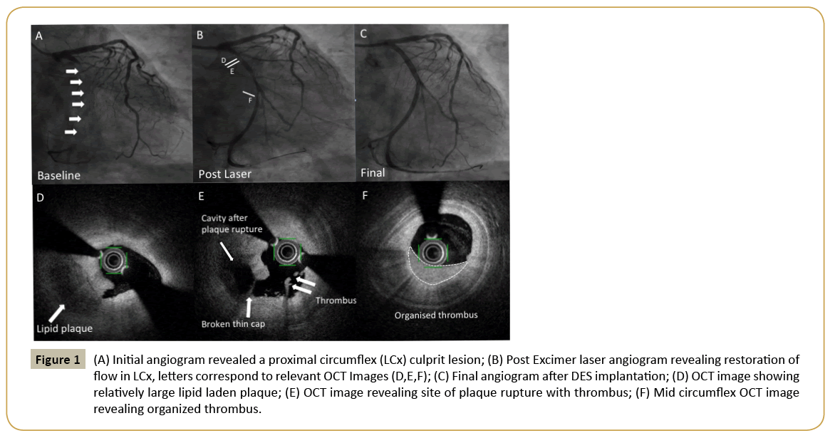 interventional-cardiology-Initial-angiogram