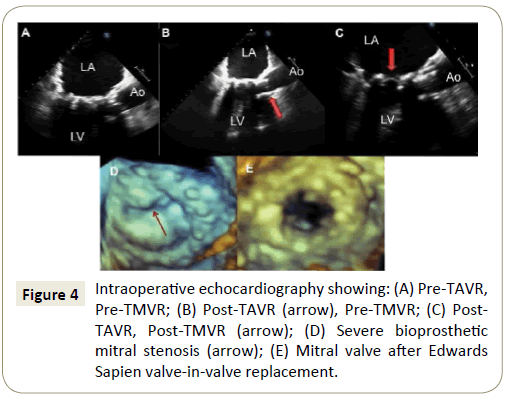 interventional-cardiology-Intraoperative-echocardiography