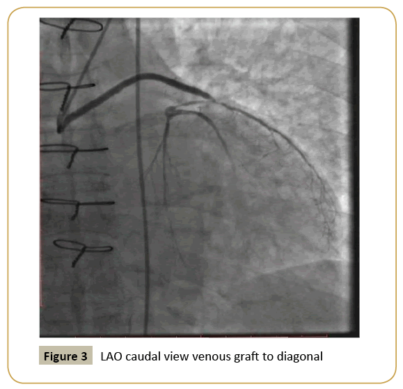 interventional-cardiology-LAO-caudal