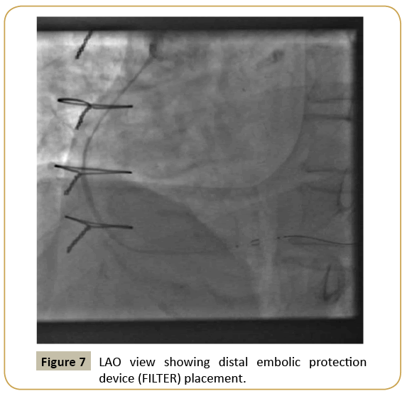 interventional-cardiology