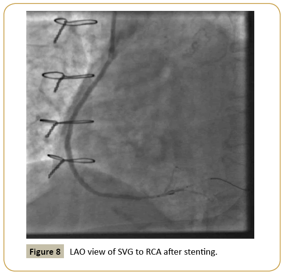 interventional-cardiology-LAO-view