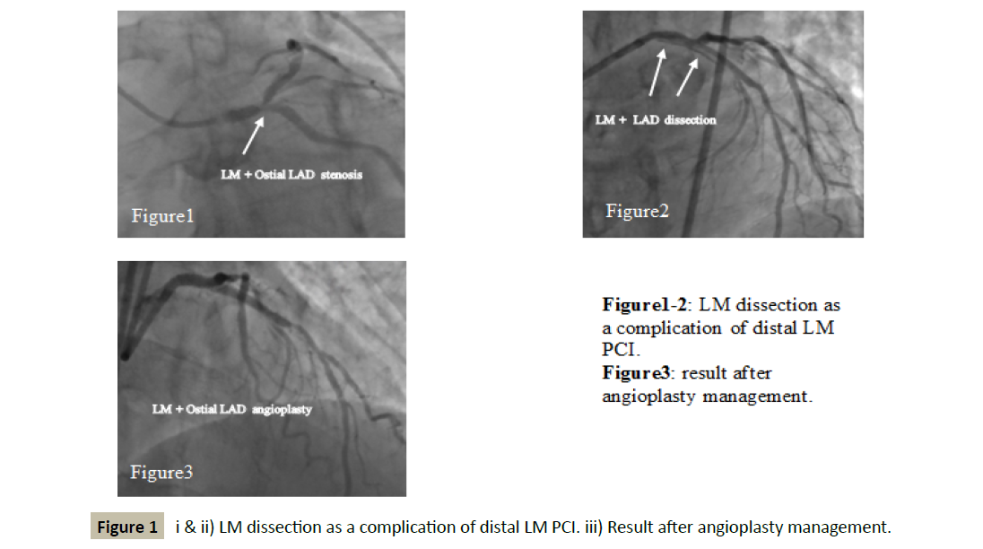 interventional-cardiology-LM-dissection