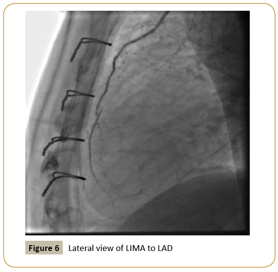 interventional-cardiology-Lateral-view