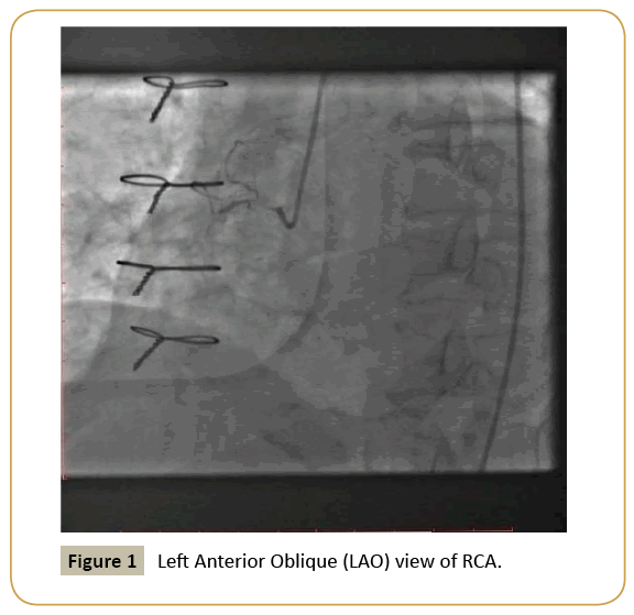 interventional-cardiology-Left-Anterior