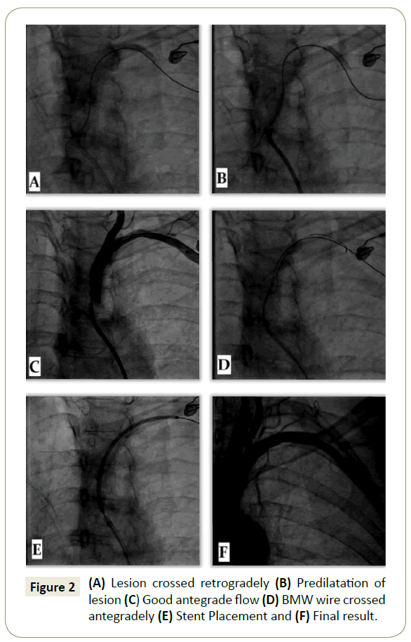 interventional-cardiology-Lesion-crossed