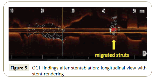 interventional-cardiology-OCT-findings