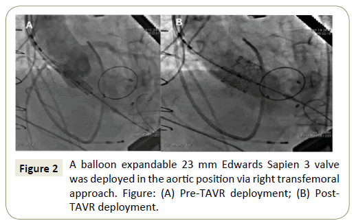 interventional-cardiology-Post-TAVR-deployment