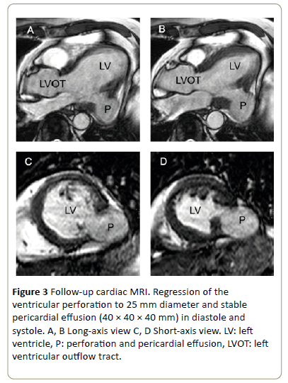 interventional-cardiology-Regression-ventricular-perforation