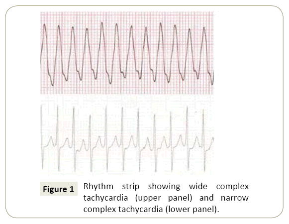 interventional-cardiology-Rhythm-strip