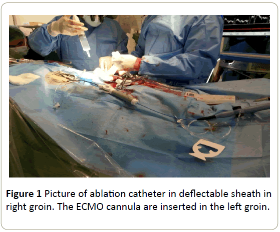 interventional-cardiology-ablation-catheter-sheath
