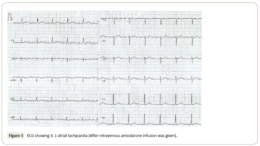 interventional-cardiology-amiodarone