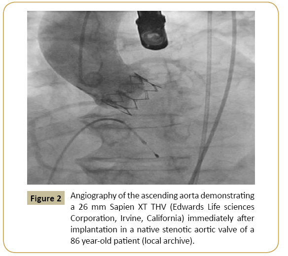interventional-cardiology-ascending-aorta