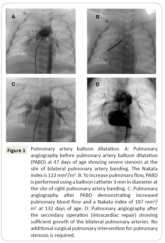 interventional-cardiology-balloon-dilatation