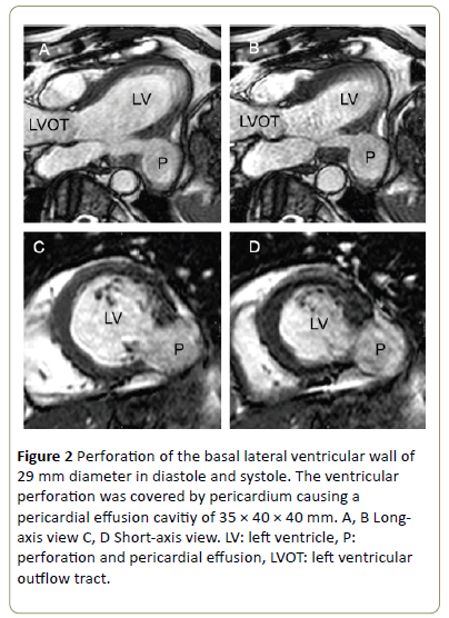 interventional-cardiology-basal-lateral-ventricular-wall