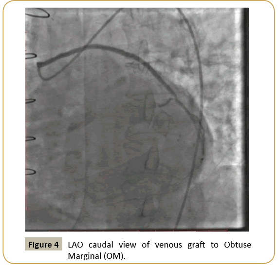 interventional-cardiology-caudal-view