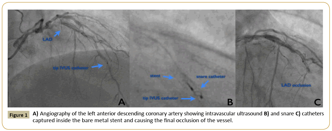 interventional-cardiology-coronary-artery