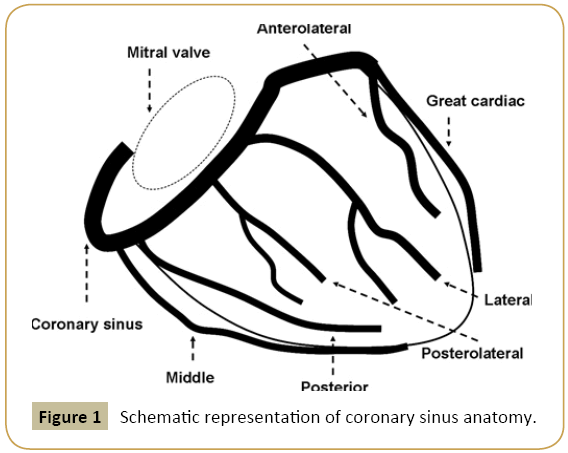 interventional-cardiology-coronary-sinus