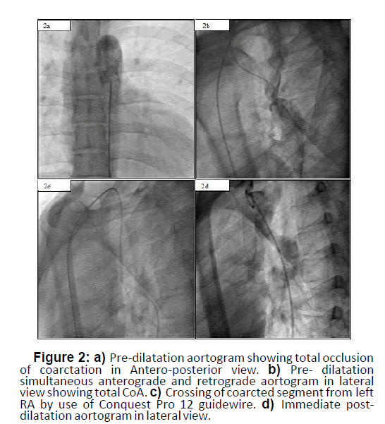 interventional-cardiology-dilatation-aortogram