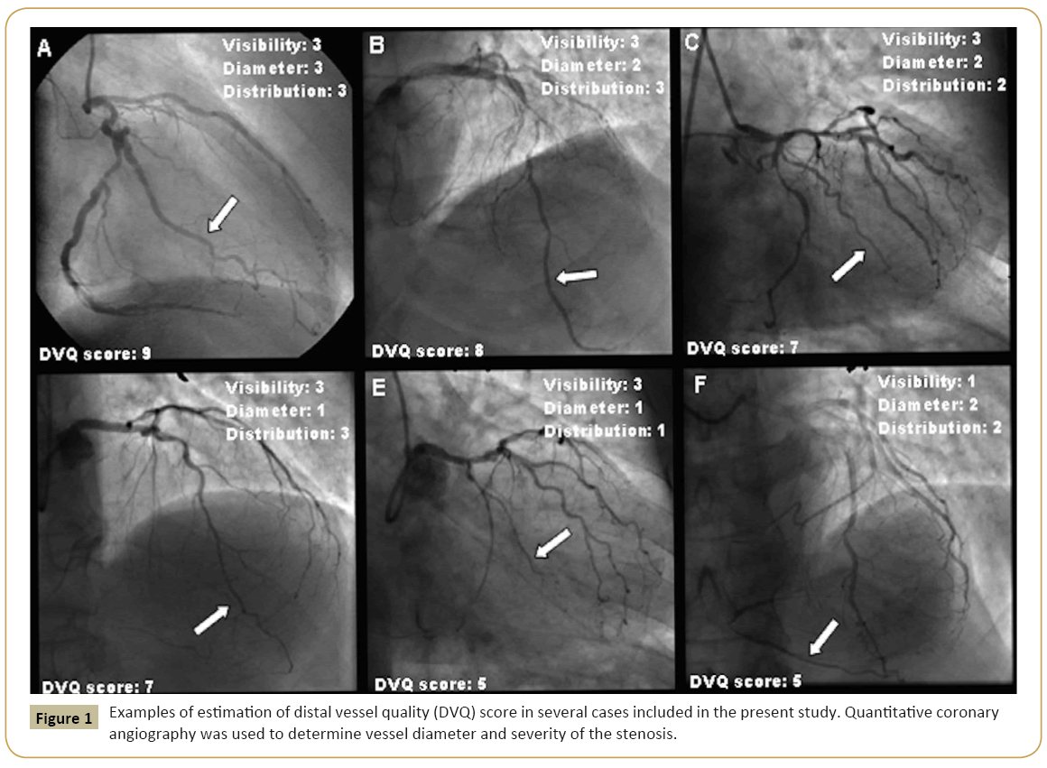 interventional-cardiology-distal-vessel